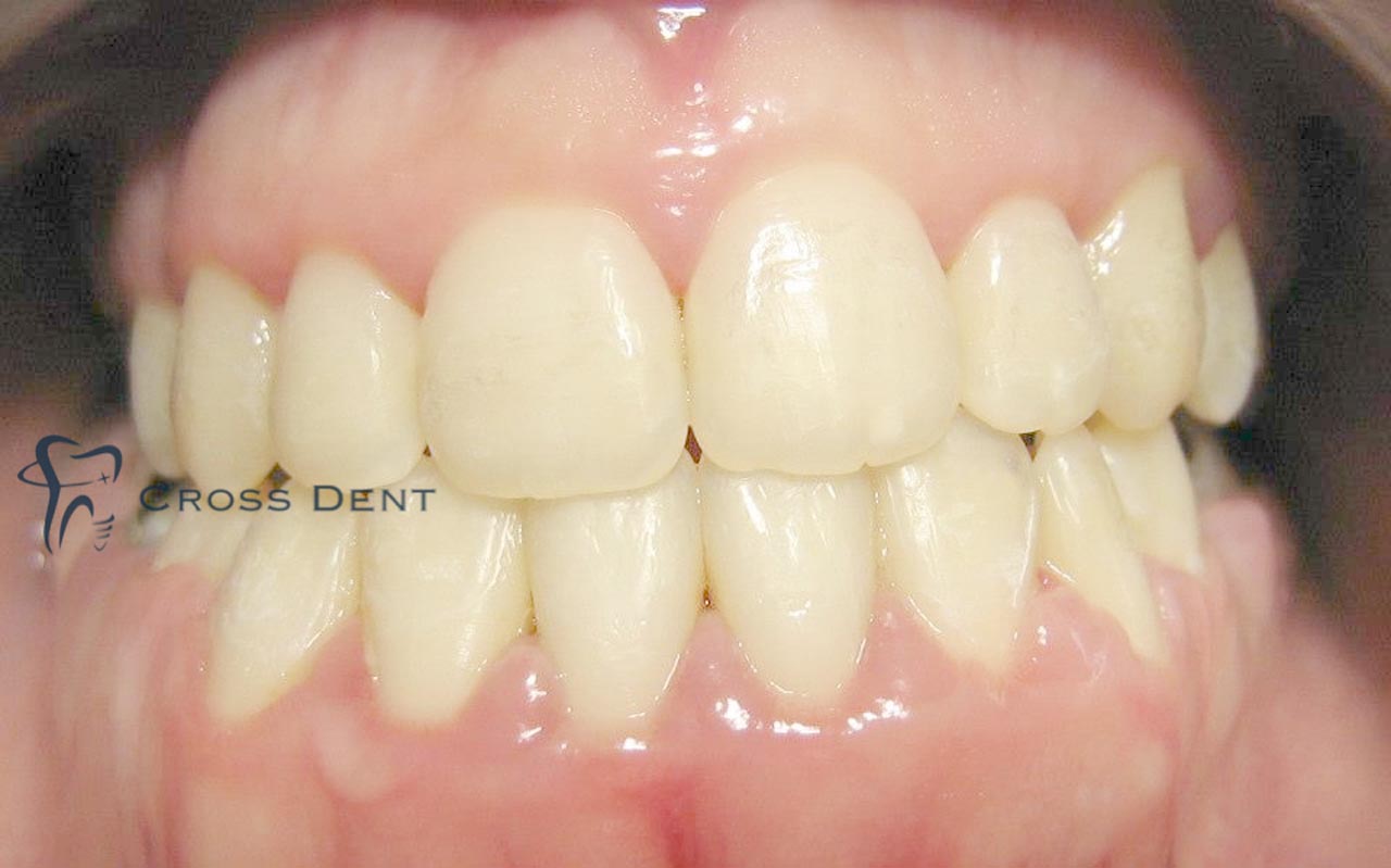 След ортодонтско лечение в Cross Dent Пловдив