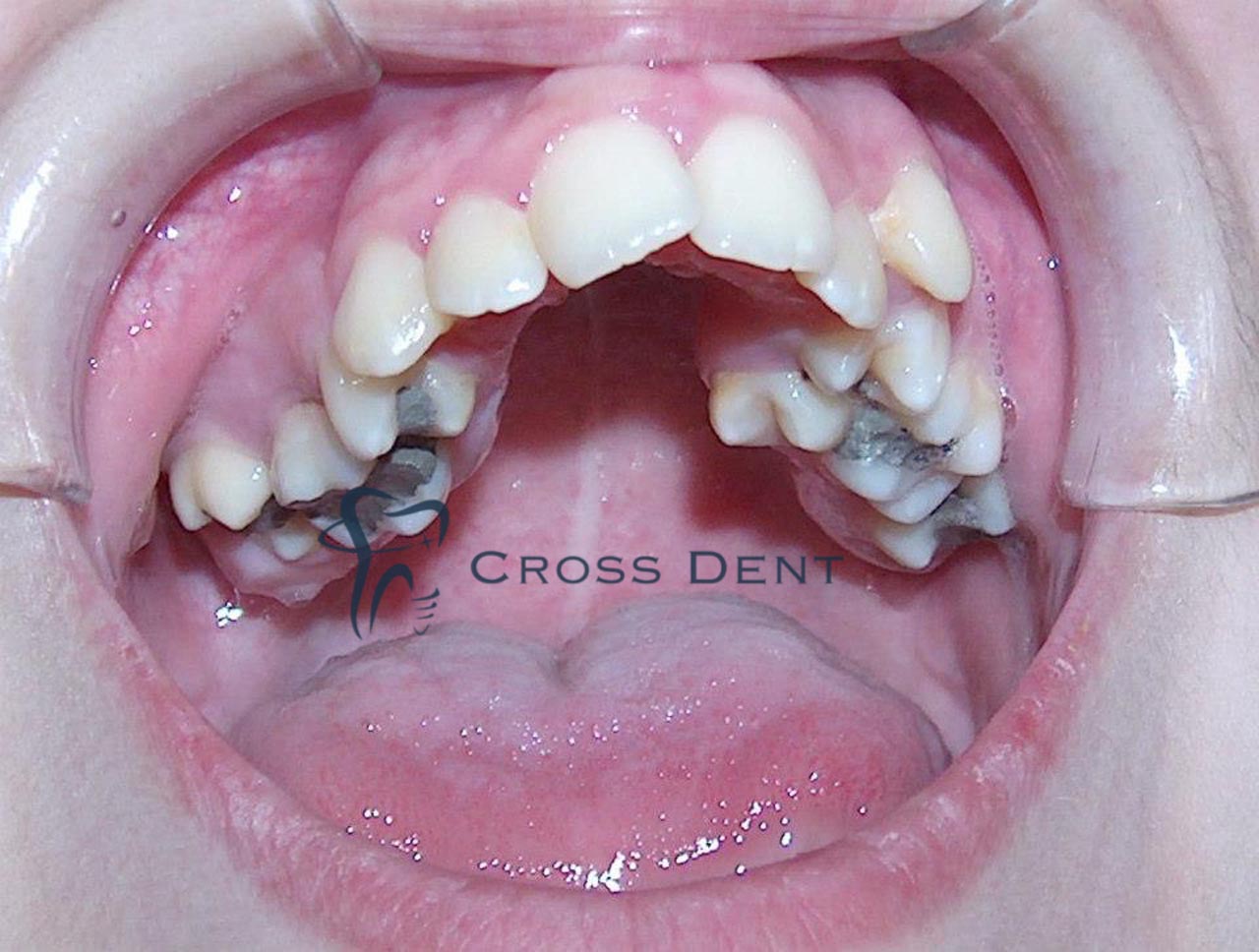 Преди ортодонтско лечение в Cross Dent Пловдив